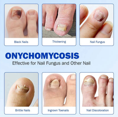 FungaFix Nail Patches