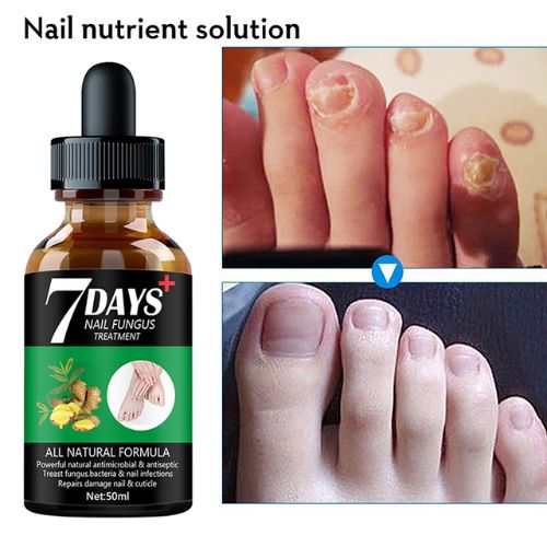 Foot Nail Fungus Treatment Serum ViralGalleria.com