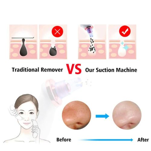 Blackhead Removal Suction Tool ViralGalleria.com