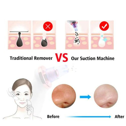 Blackhead Removal Suction Tool ViralGalleria.com