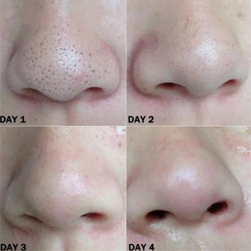 Nose Blackhead Remover Strips ViralGalleria.com