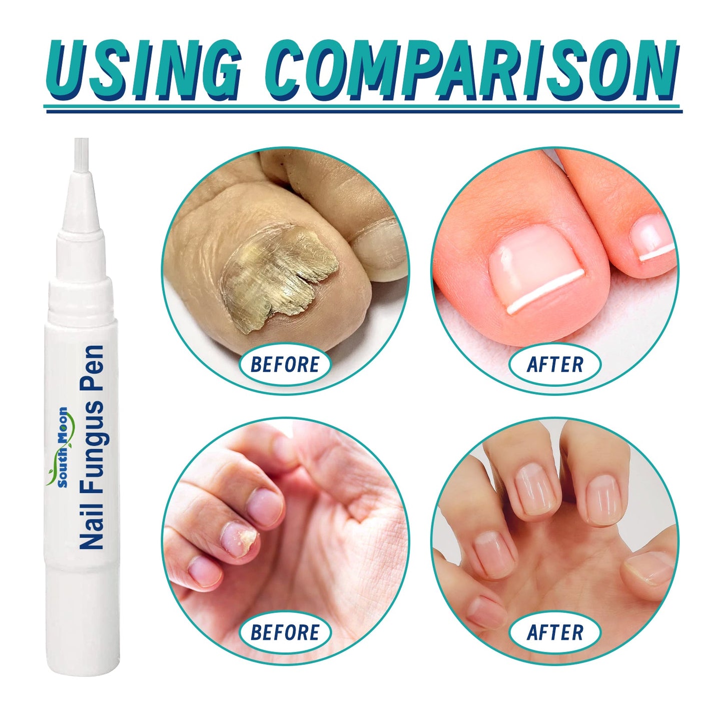 Nail Repair Pen, Repair Hands And Feet Gray Nails Brightening Nails Soft Nails Thickening Nails Moisturizing Care