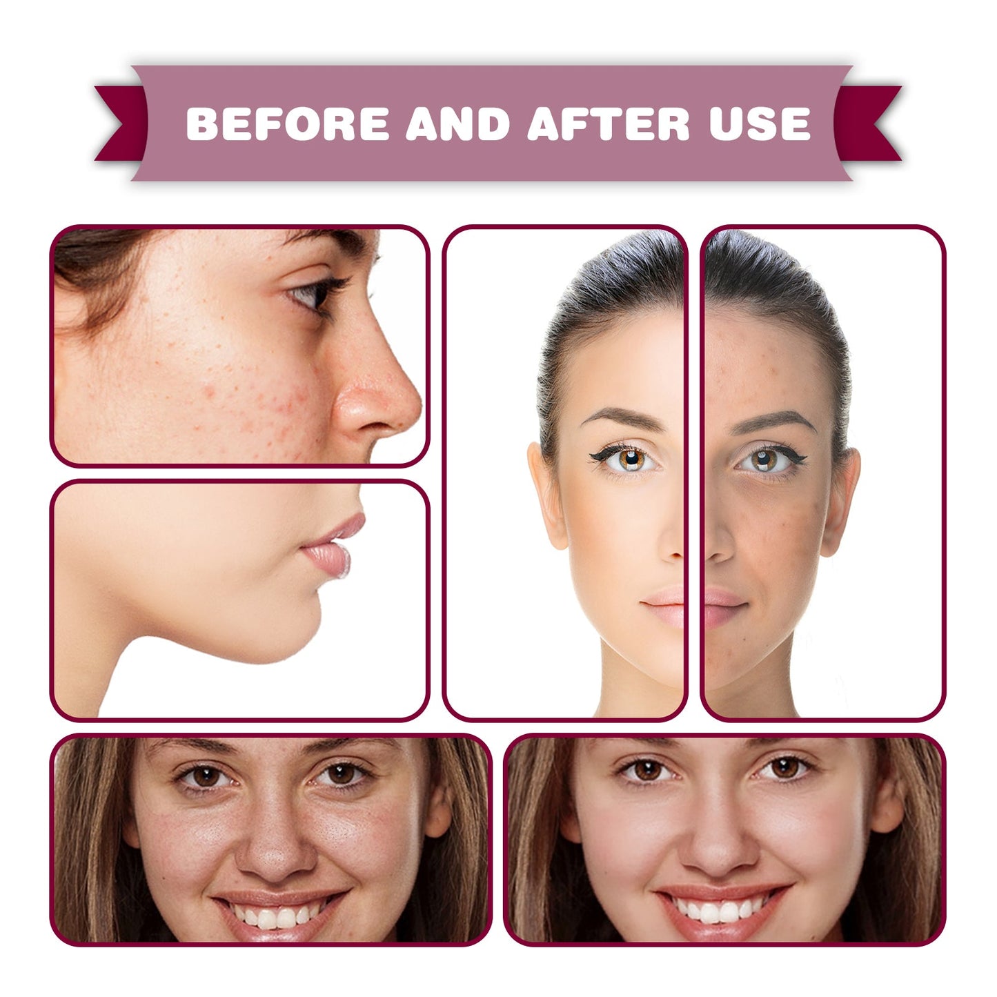 Acid Essence, Shrinks Pores, Removes Blackheads, Pimples And Acne Marks, Brightens Skin Tone Moisturizing Essence