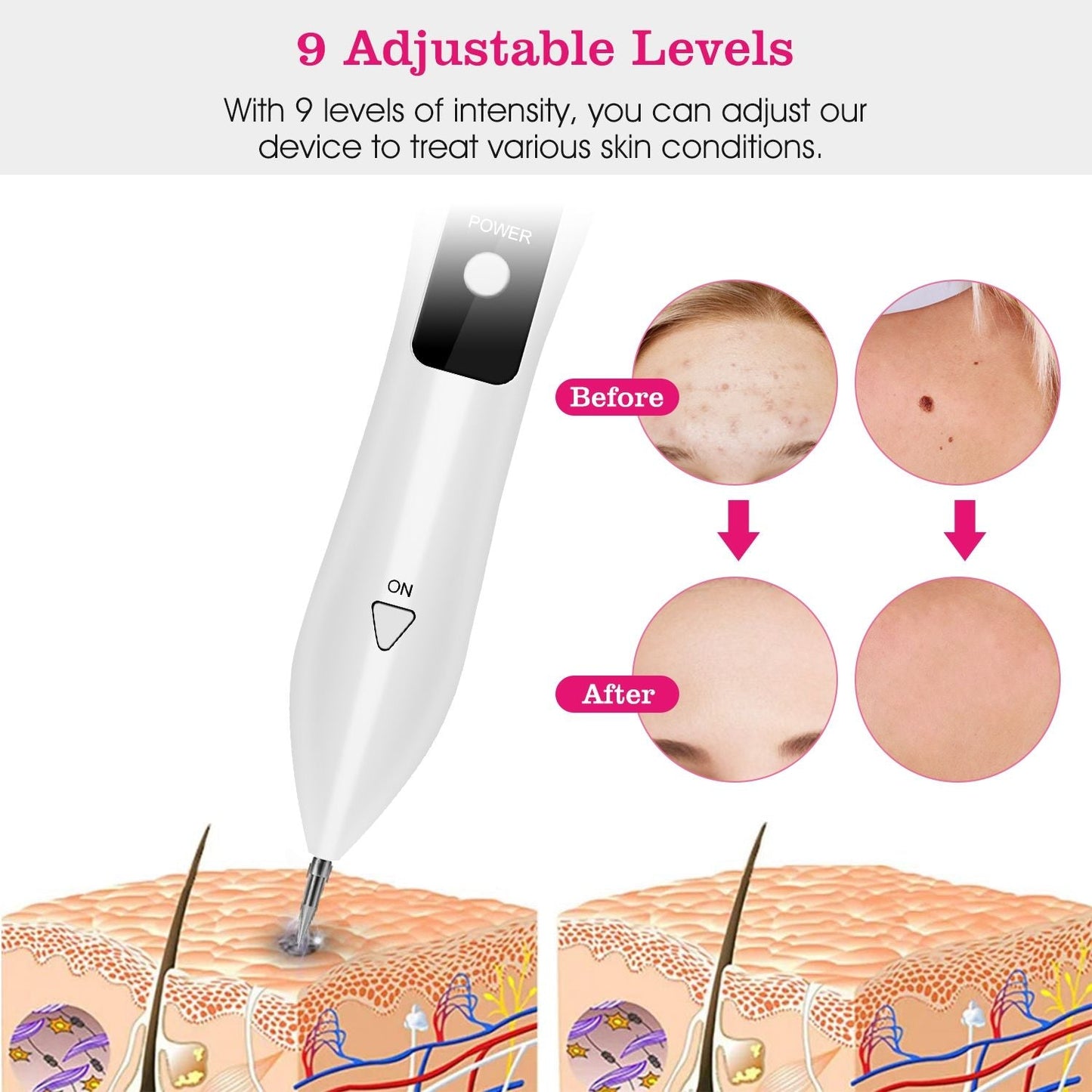 Skin Tag Repair Kit Portable Beauty Equipment Multi-Level with Home Usage USB Charging LCD Level Adjustable 6 Replaceable Needles New Era Fashion LLc